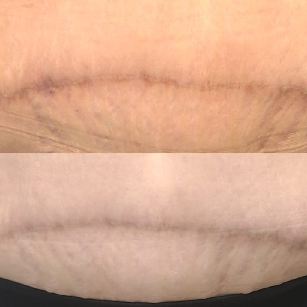 Abdominoplasty Camouflage