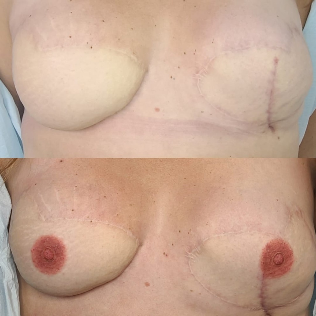 Bilateral Areola Reconstruction