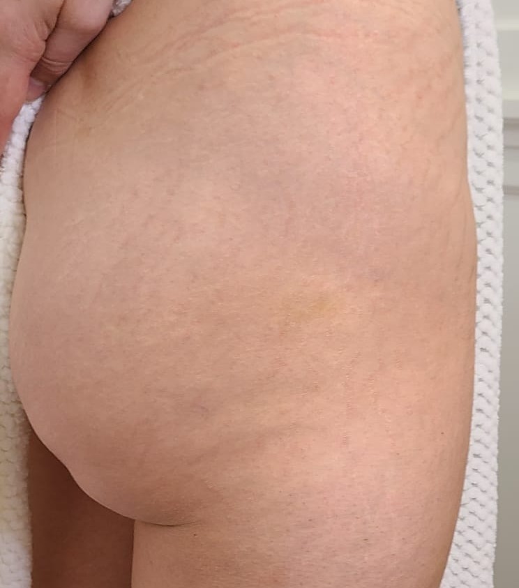 Stretch Mark Camouflage