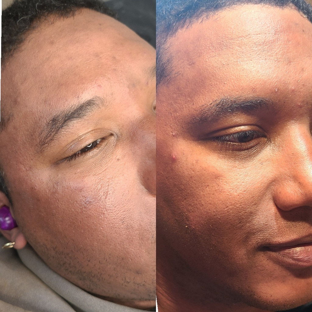 Male Brow Enhancement